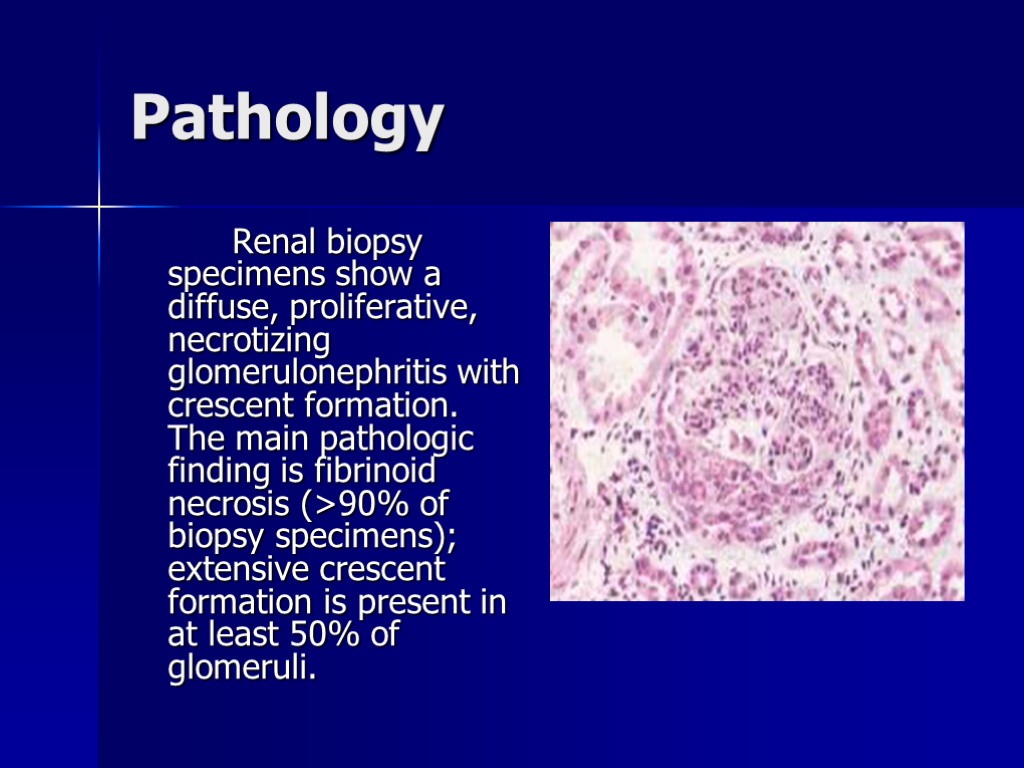 Pathology Renal biopsy specimens show a diffuse, proliferative, necrotizing glomerulonephritis with crescent formation. The